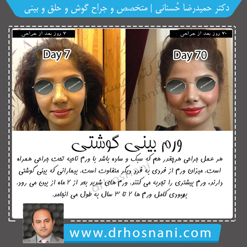 جراحی بینی دکتر حسنانی - ورم بینی