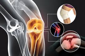 انواع آرتروز زانو