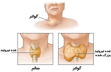 گواتر