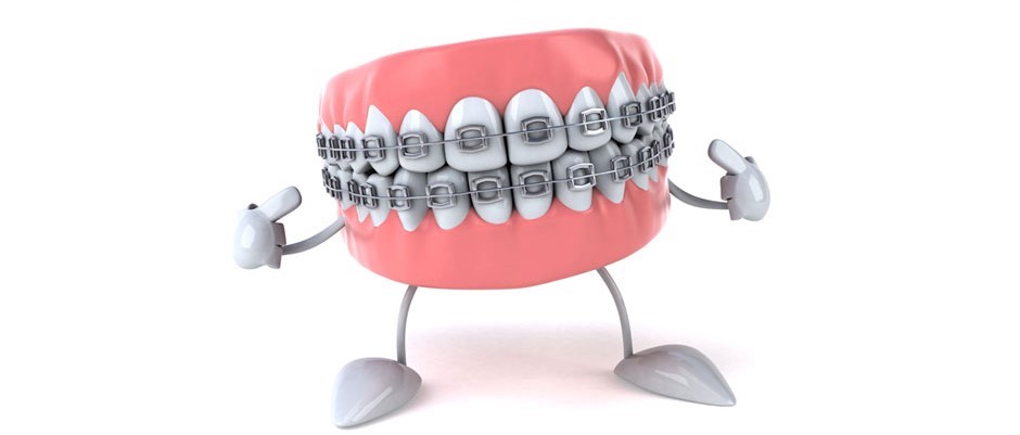 معایب و مزایای براکت فلزی ارتودنسی