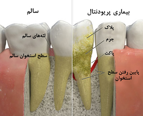تحلیل رفتگی لثه